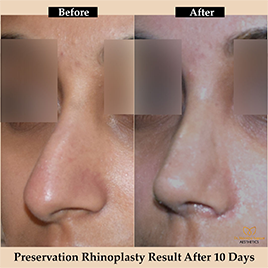 rhinoplasty-img9